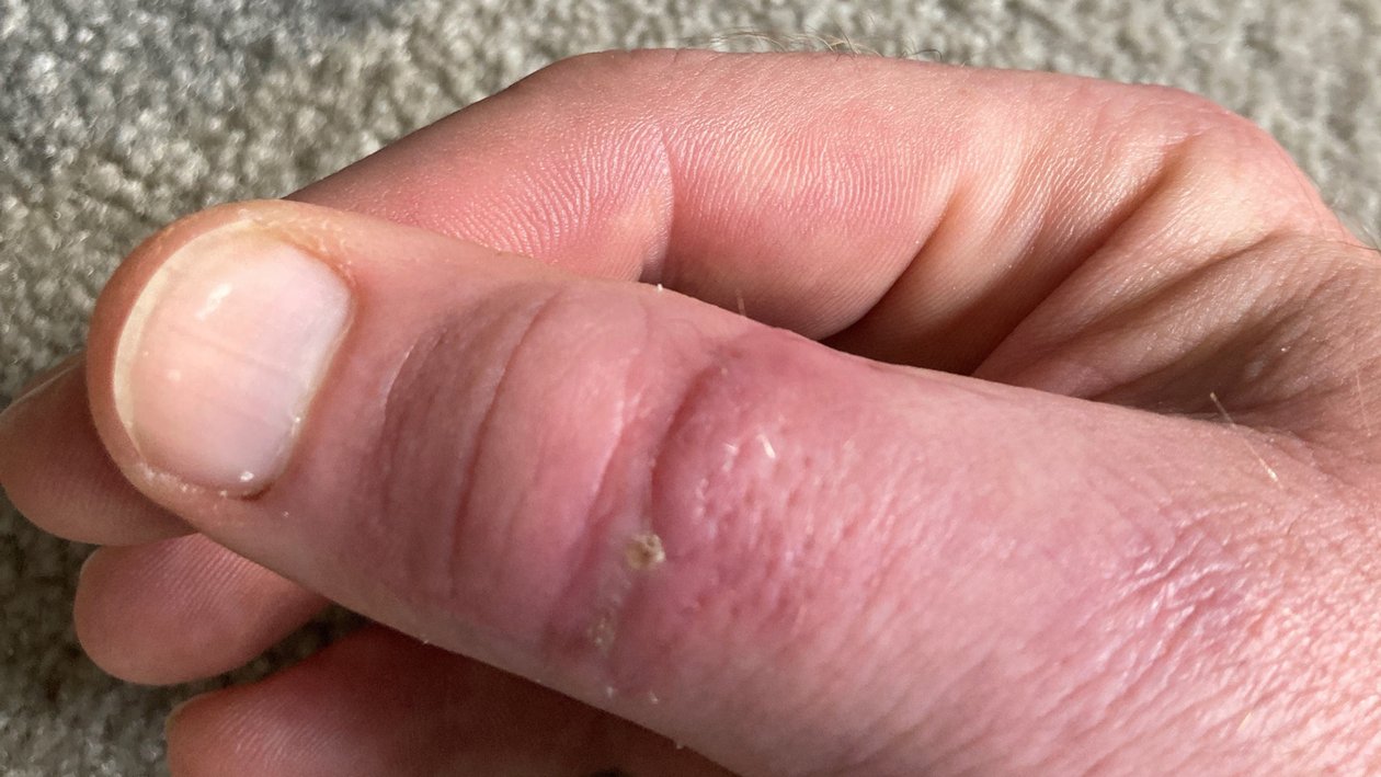 Schnittwunde am Daumen, Nachher-Bild