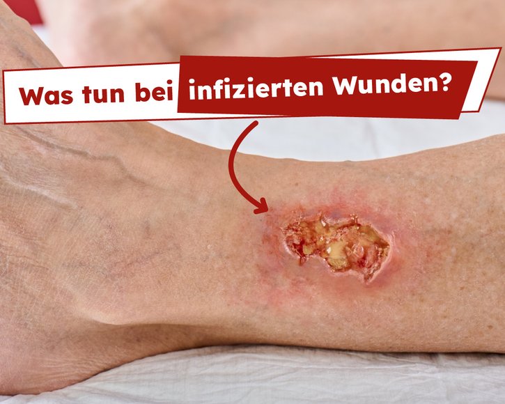 Sommer, Hitze und infizierte Wunden: Neues Online-Seminar
