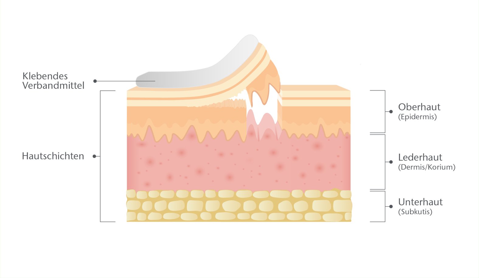 MARSI: Ablösung der Epidermis