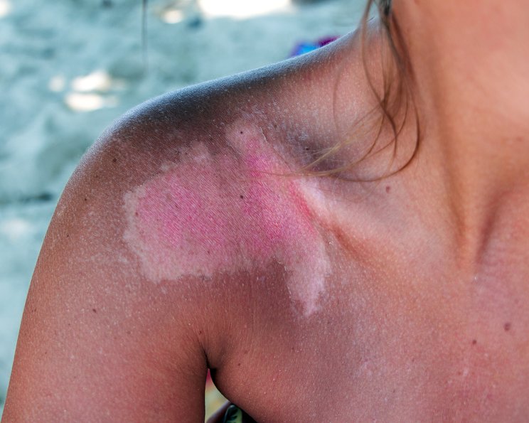 Wundpflege im Sommer