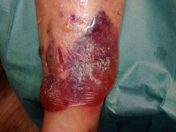 Ulcus cruris venosum nach Trauma