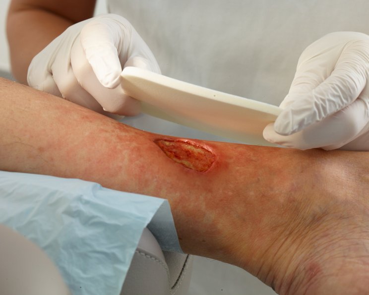 Mikroklima und Wundheilung