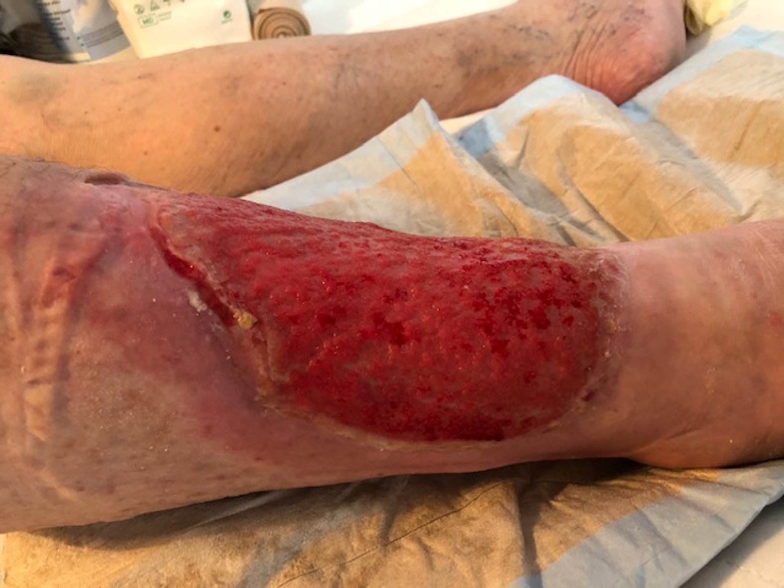 Ulcus am rechten Unterschenkel 6