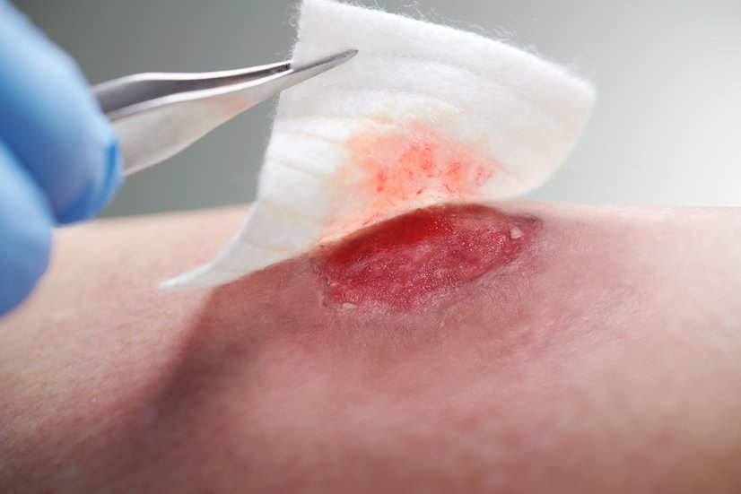 DracoHydrofaser - Hydrofaser-Wundauflage auf einer Wunde