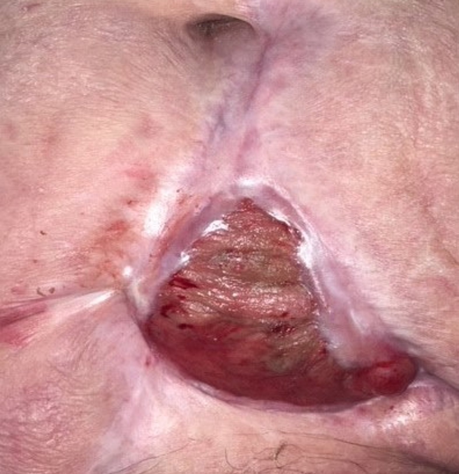 Bauchwunde mit Stomaanlagen – Nach 35 Wochen