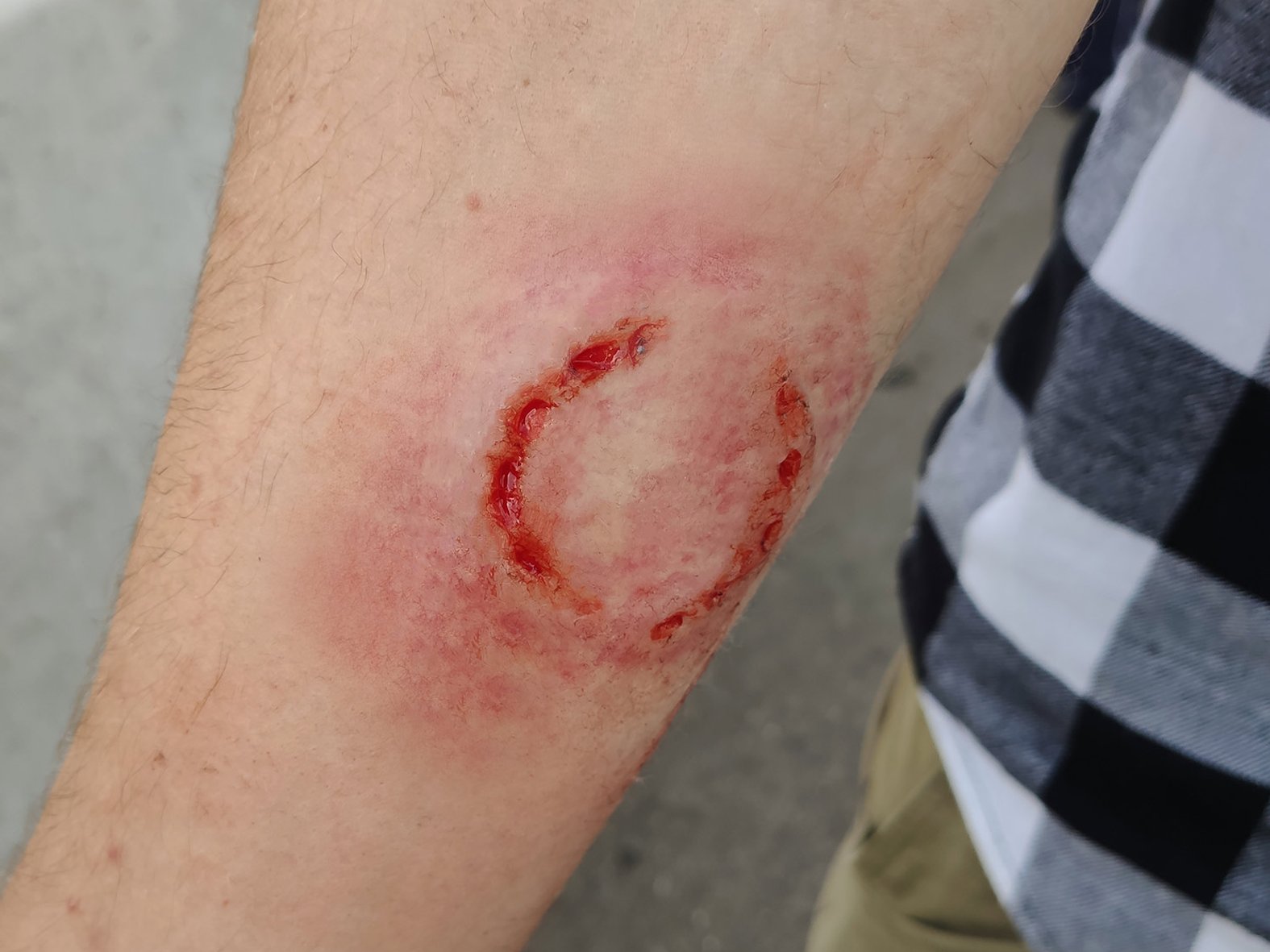 Bisswunde durch einen Erwachsenen