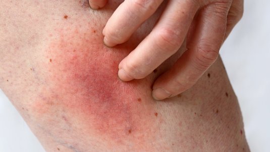 Allergien bei chronischen Wunden