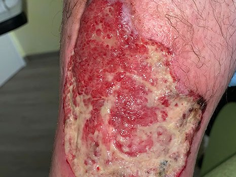 Pyoderma gangraenosum