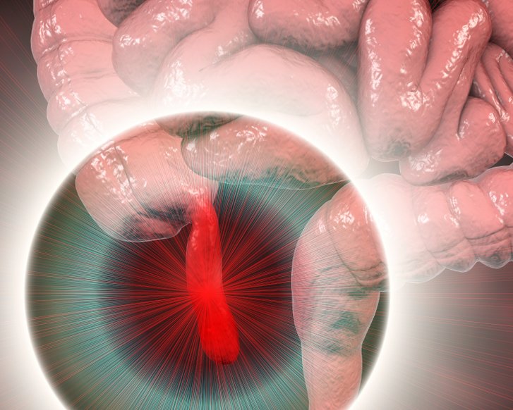 Appendizitis, schematische Darstellung