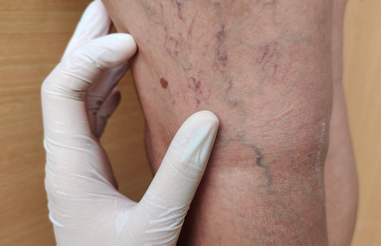 Varizen - Besenreiser am Oberschenkel