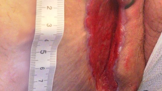 Zurück in den Alltag: Fallbeispiel Sekundärheilende Wunde nach Abszessspaltung