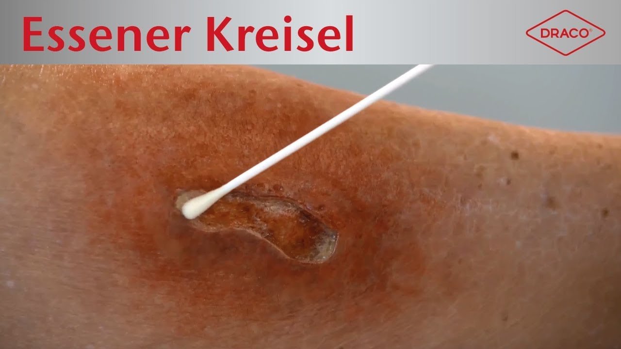 Video: Essener Kreisel, Wundabstrich