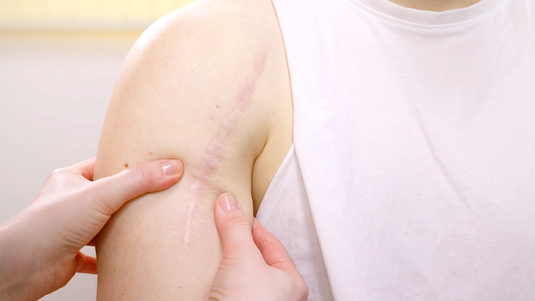 Kurz und kompakt: Narben pflegen