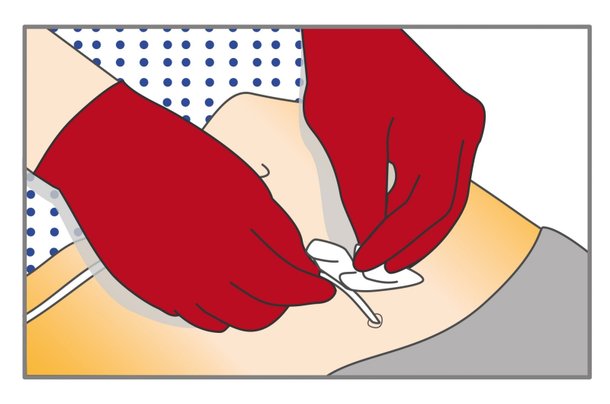 verbandwechsel-katheter-schritt-3