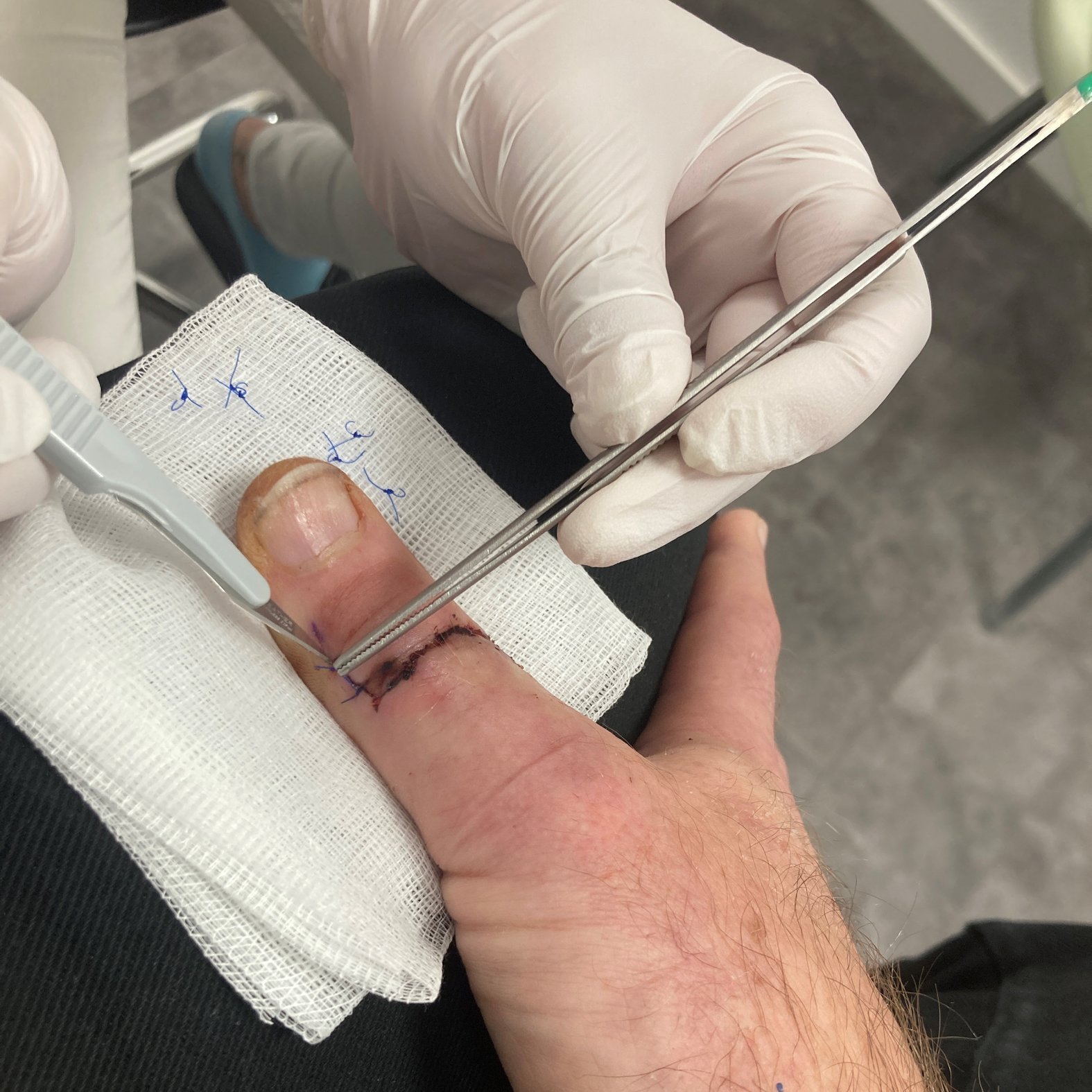 Fäden ziehen: Entfernen der Wundnaht, Schnittwunde