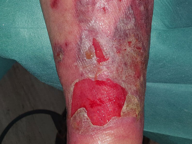 Ulcus cruris venosum nach Trauma
