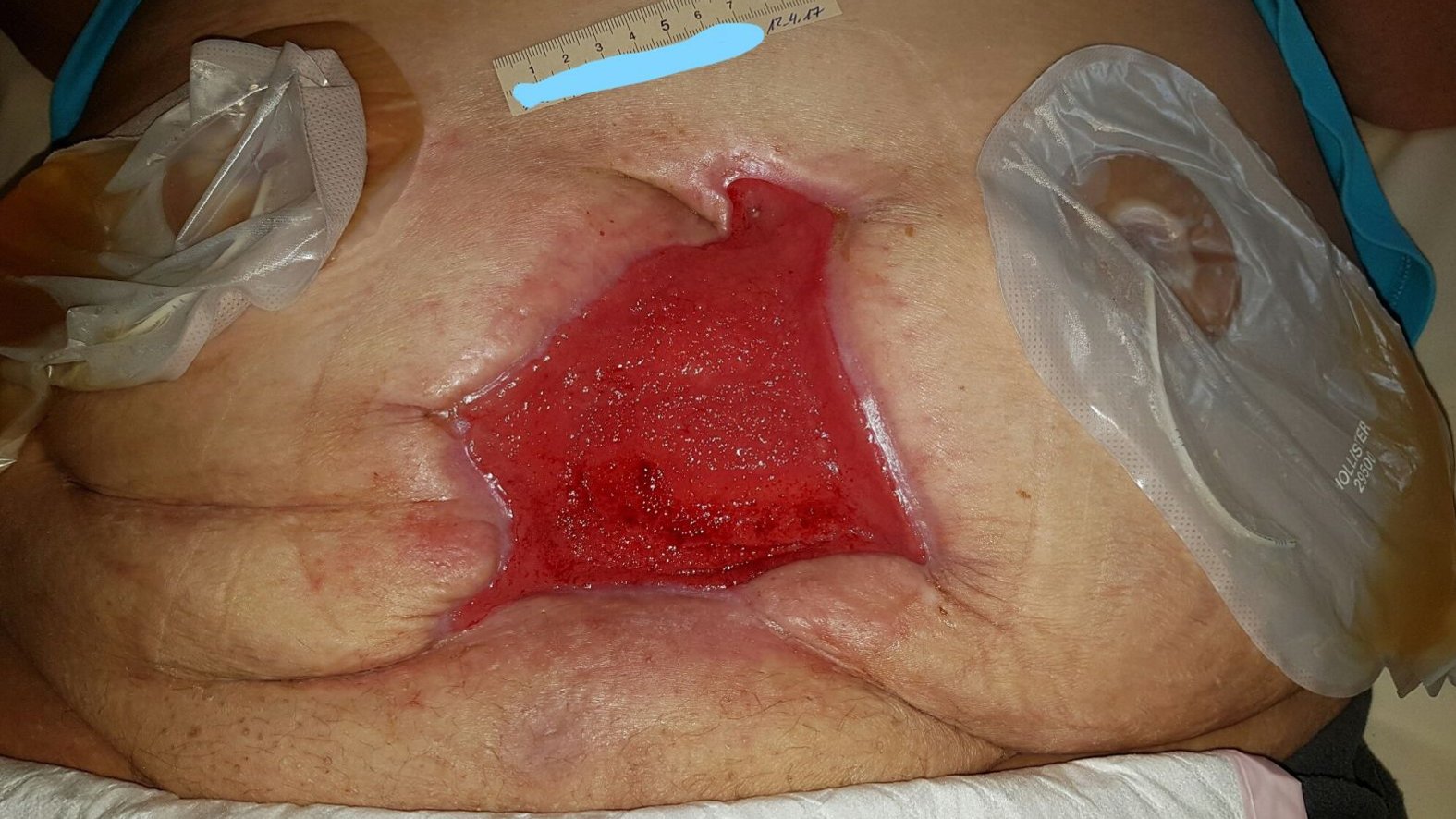 Bauchwunde mit Stomaanlagen – Beginn der Behandlung