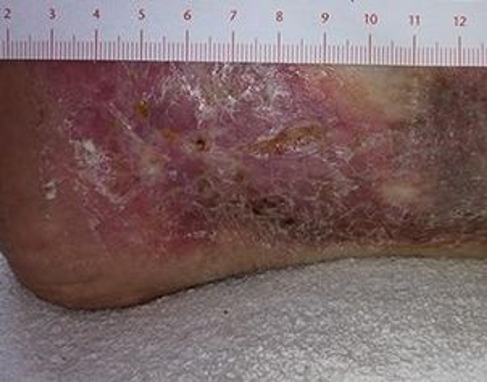 Wundumgebungshaut Sklerose