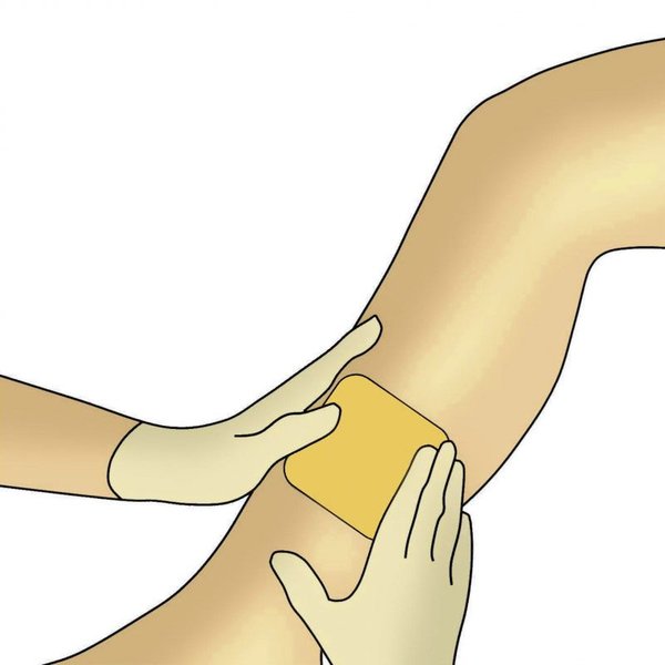 Dracohydro Verbandwechsel Schritt 5
