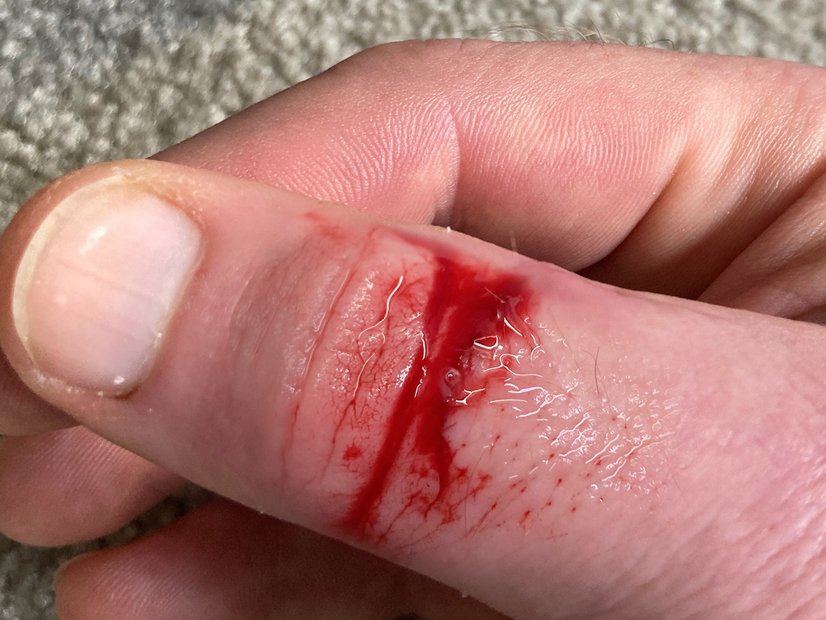 Schnittwunde am Daumen, Vorher-Bild