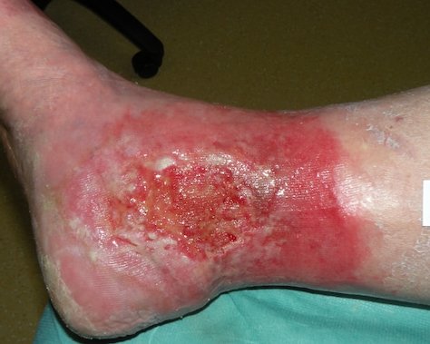 Chronische Wunden: Neuer Ansatz für Therapien 