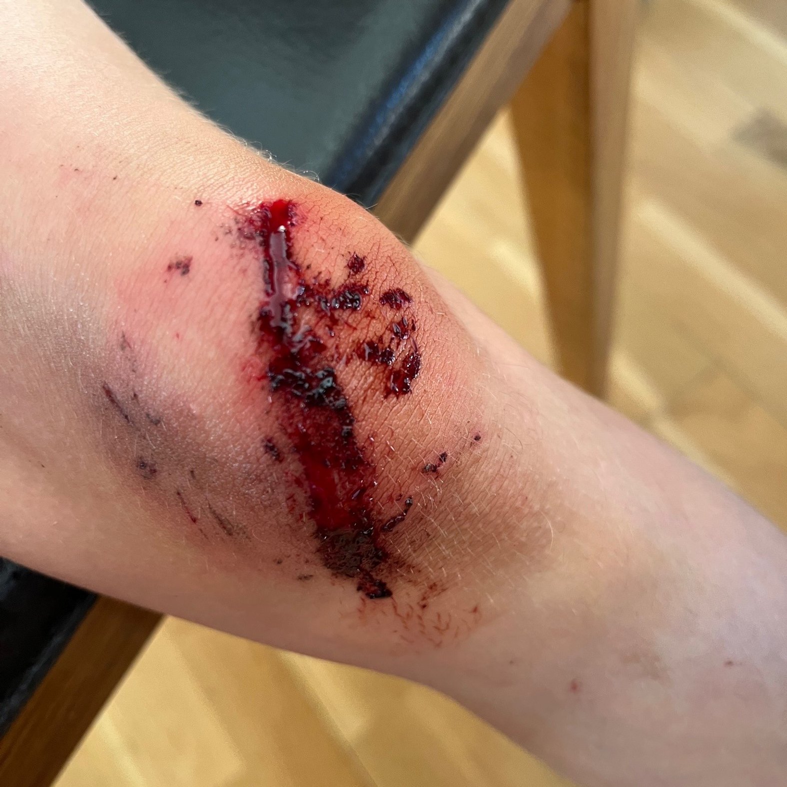 Frische Schürfwunde am Knie eines Kindes