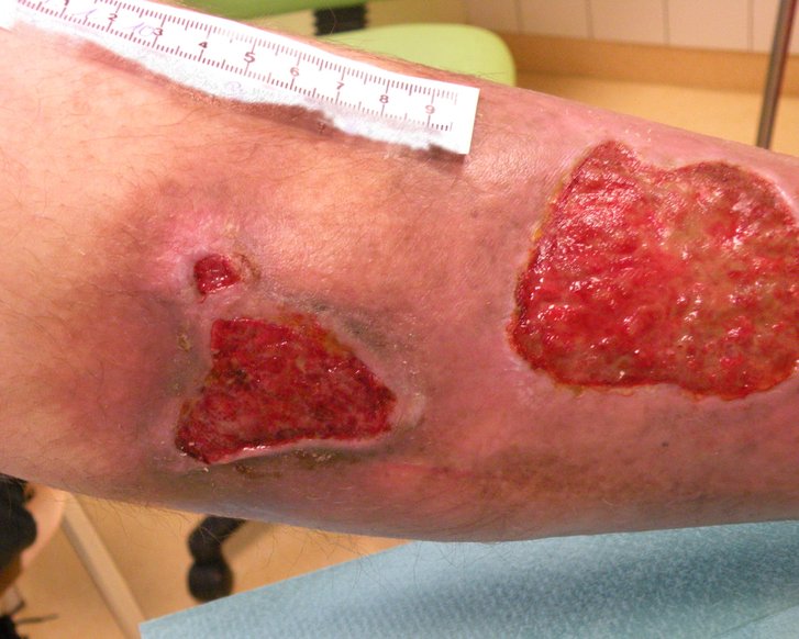 Ulcus cruris, arterielle und venöse Ursachen