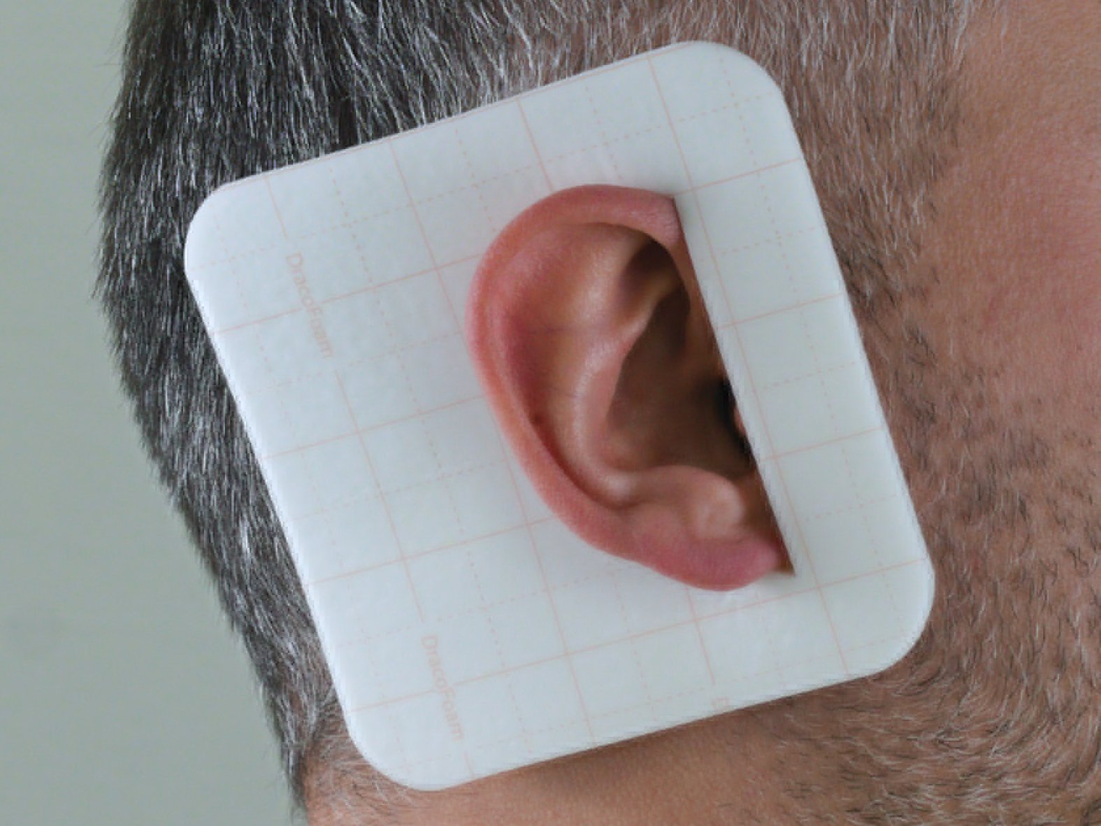 Dracofoam-Zuschnitt zur Versorgung einer Wunde hinter dem Ohr. 