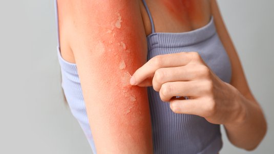 Spezielle Wunden – Verbrennungen