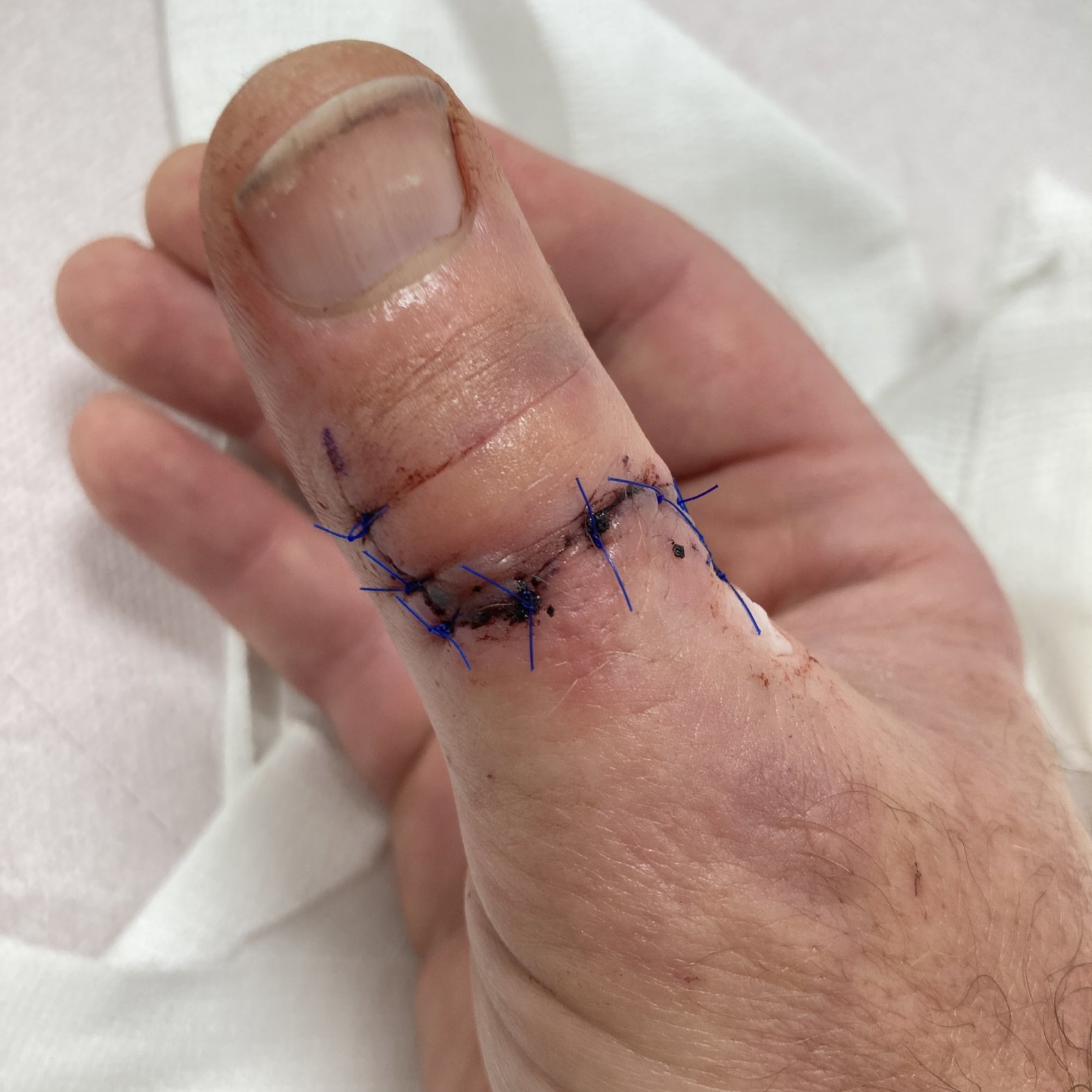 Foto 6: Wunde beim ersten Verbandwechsel nach der OP