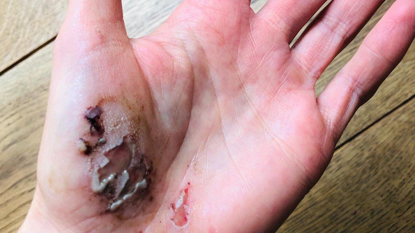 Frische Schürfwunde an der Hand