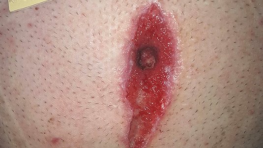 Nahtdehiszenz nach Nabelbruch - Fallbeispiel Tiefe Wunde nach Operation