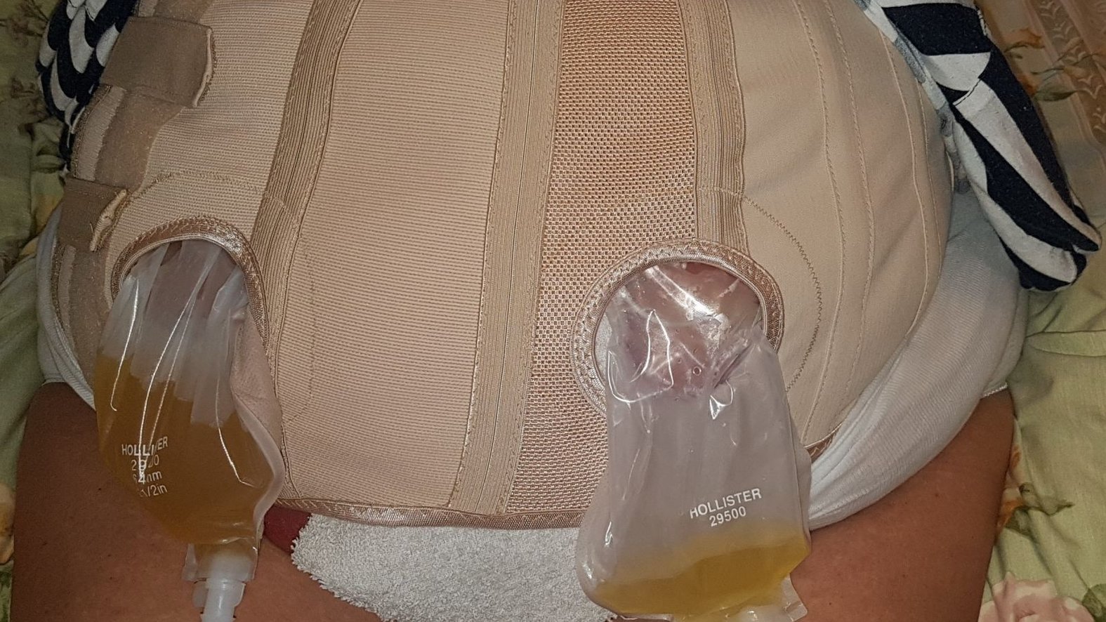 Bauchwunde mit Stomaanlagen – Zusätzliche Fixierung mit speziellem Mieder