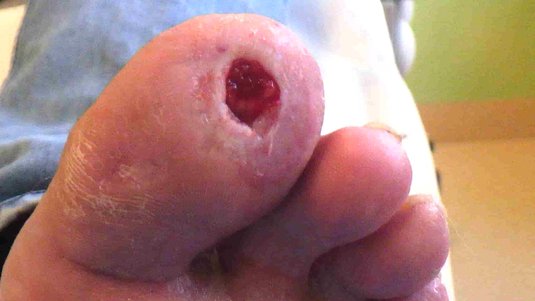 Fallbeispiel: Abszess am Zeh nach Trauma