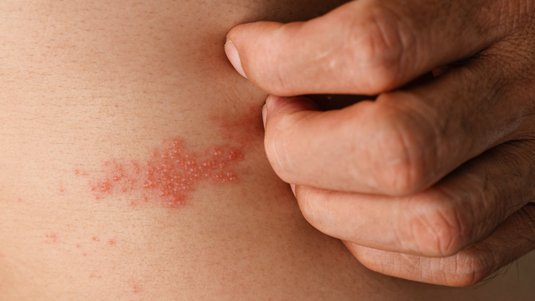 Die Qualen bei der Gürtelrose