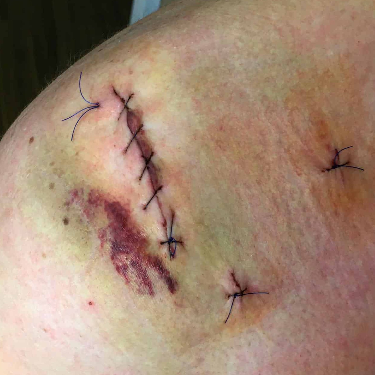OP-Wunde an der Schulter