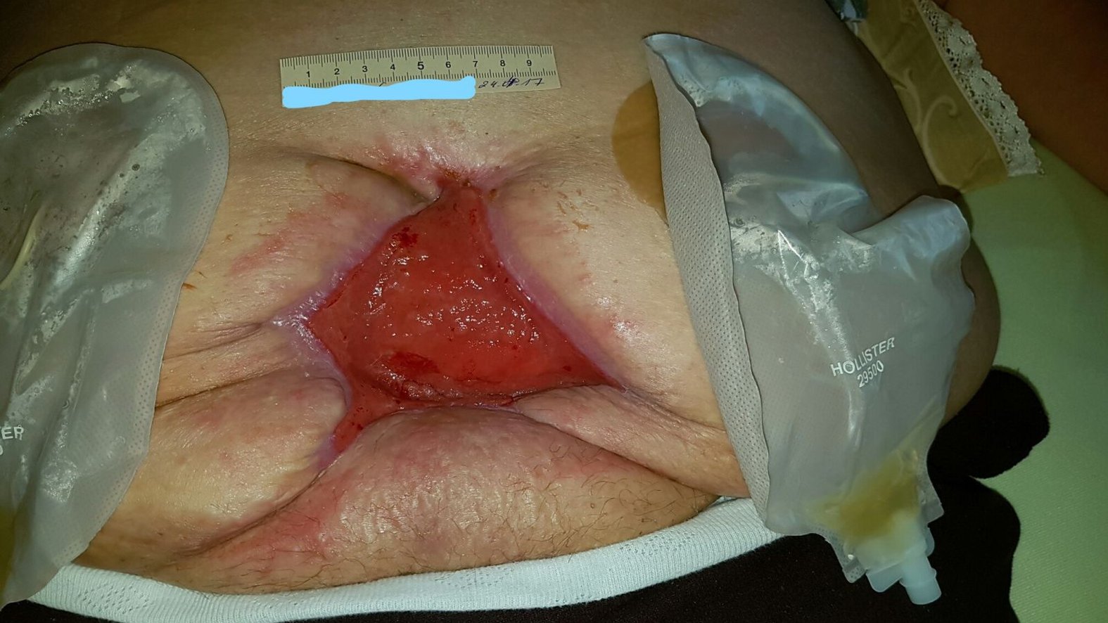 Bauchwunde mit Stomaanlagen – nach 14 Tagen