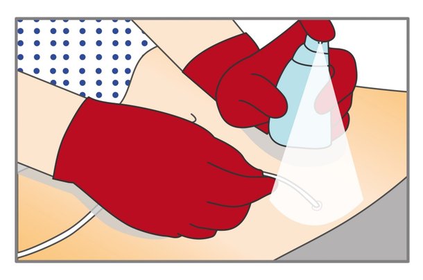 verbandwechsel-katheter-schritt-2