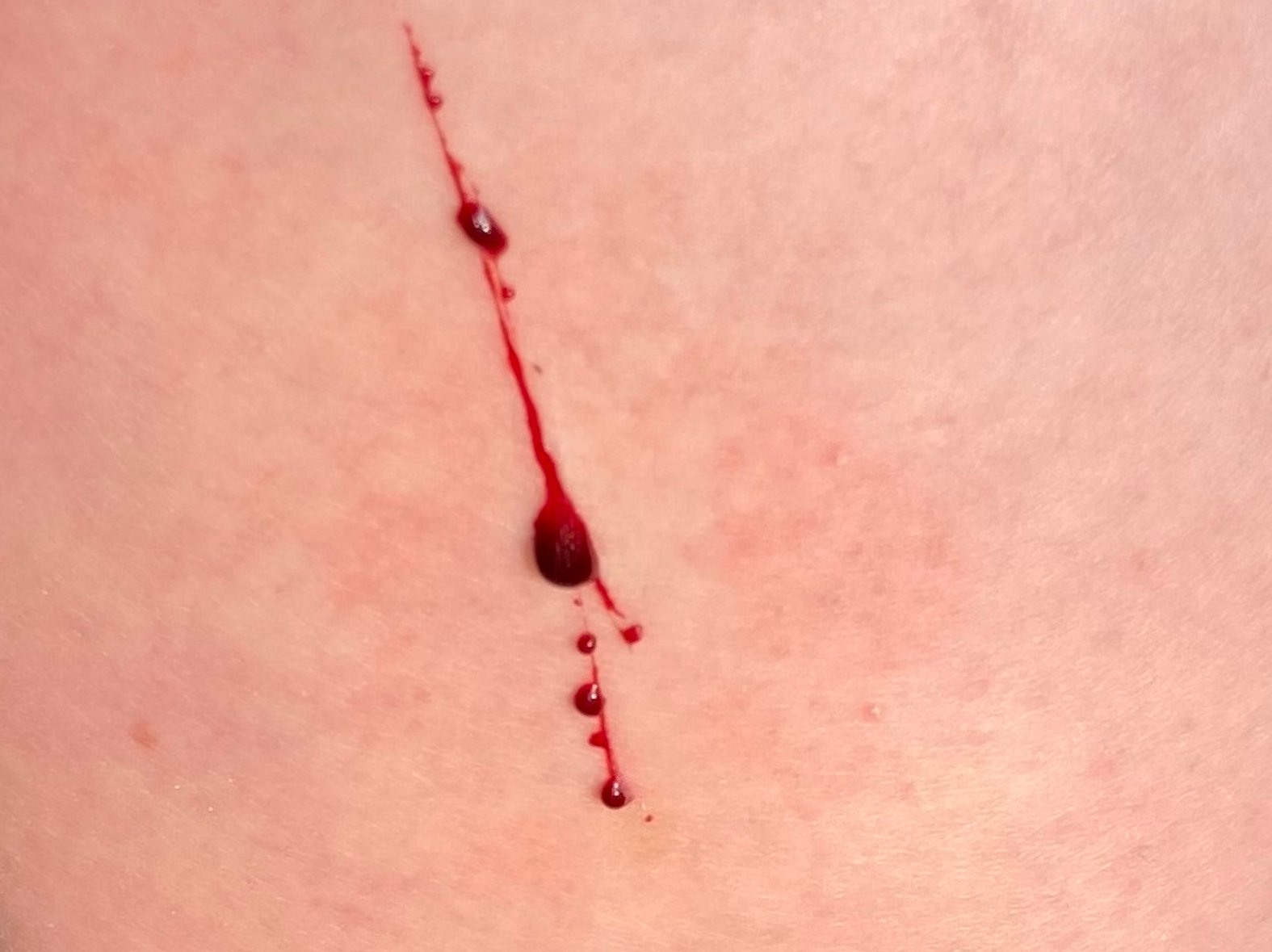 Frische Kratzwunde, leichte Blutung