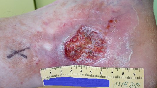 Fallbeispiel: Ulcus cruris venosum bei Perforansveneninsuffizienz