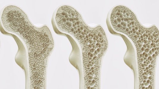 DMP Osteoporose – So funktioniert es in der Praxis