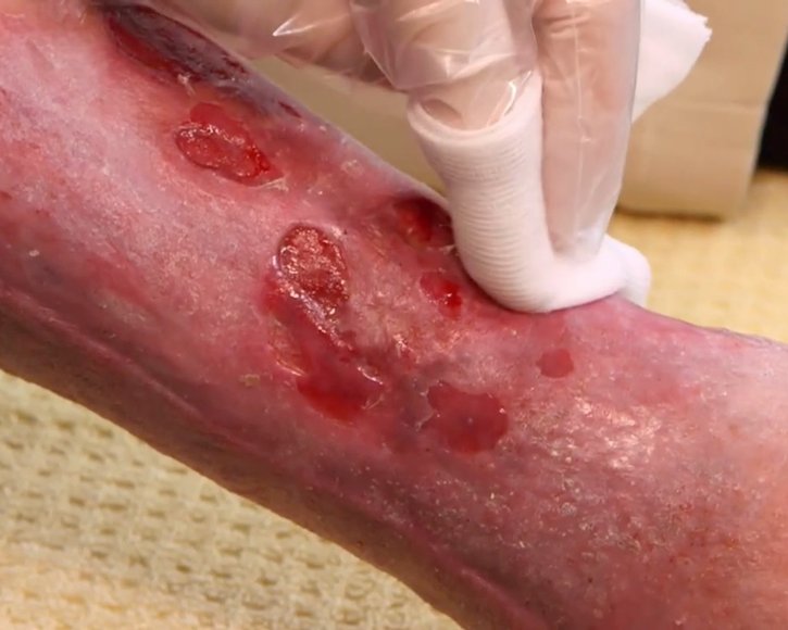 WUKO 2025: Wundreinigung und Débridement auch in der Wundumgebung