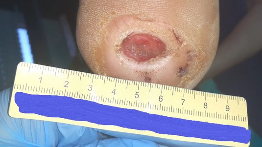 Fersenulcus bei diabetischem Fußsyndrom – Ein Fallbeispiel aus der Praxis