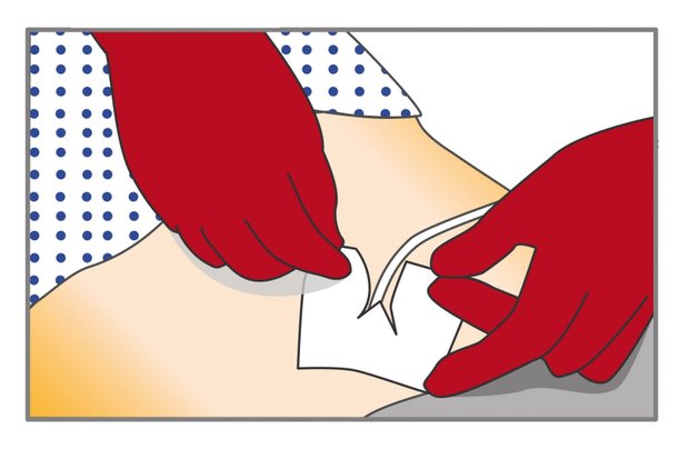 verbandwechsel-katheter-schritt-4