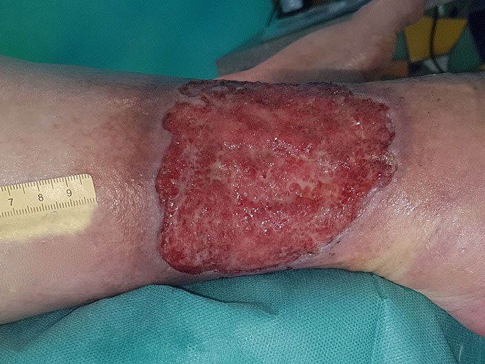 Stark exsudierende Wunde