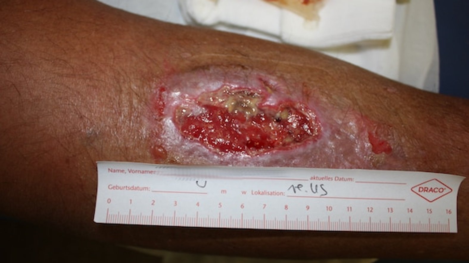 Exsudationsphase am Unterschenkel