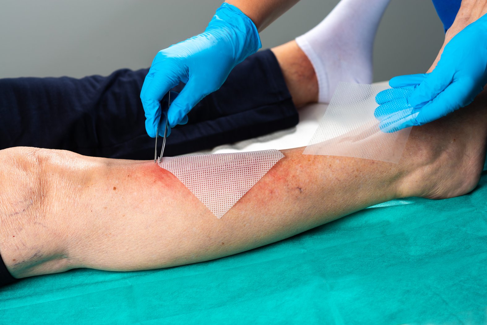 Wunddistanzgitter DracoTüll Silikon wird auf eine Wunde aufgebracht