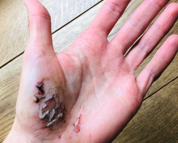 Schuerfwunde an der Hand