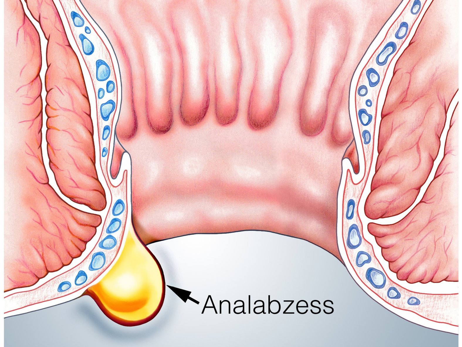 Analabszess, schematische Darstellung