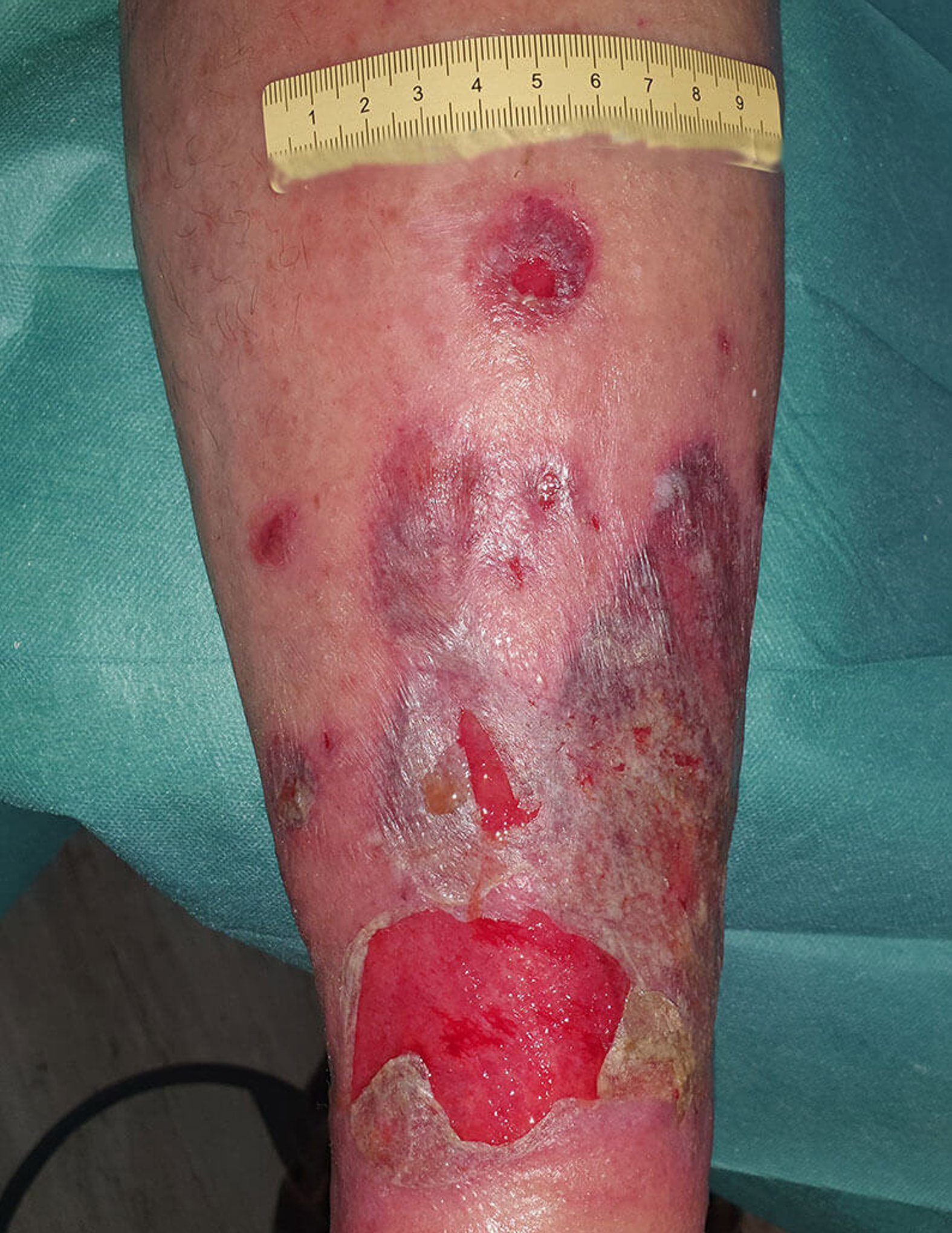 Ulcus cruris venosum nach Trauma